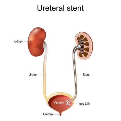 Infografic: Uretere, rinichi, vezică, stent JJ - anatomie și rol