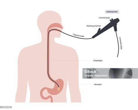 Schema montajului stentului JJ, endoscopie vs. viață postoperatorie