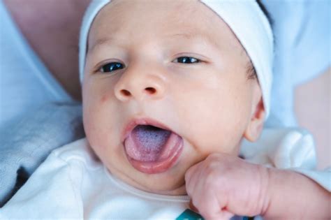 Schema de provenienta si afectare a candidozei bucale la bebelusi