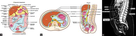 Diagramă: plasă intraperitoneal vs. plase extraperitoneale