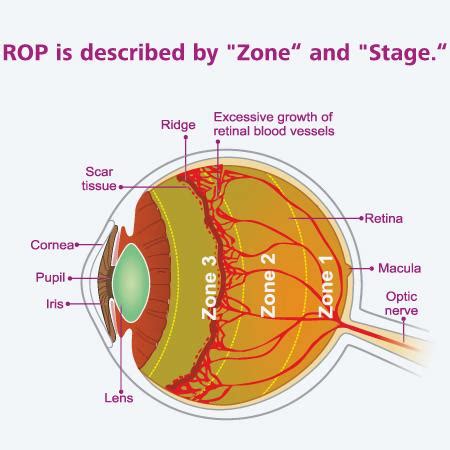 Schema localizare zone retina si stadii ROP