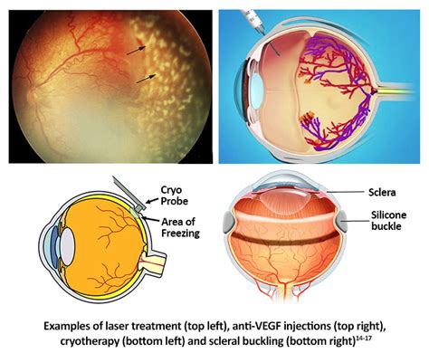 Diagramă tratament ROP: laser, crioterapie, anti-VEGF