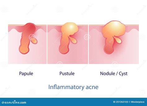 Schéma explicativ keratoza foliculară: infundibul folicular, acumulare de keratină, papule perforante