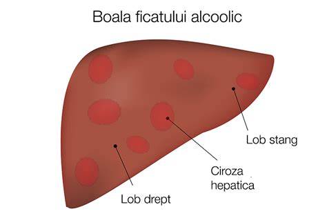 Infographic: 3 stadii ale bolii ficatului alcoolic: steatoză, hepatită, ciroză