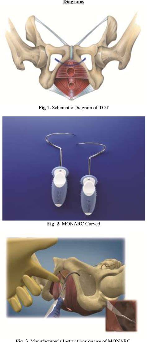 Diagramă schematizând banda TOT (transobturator tape) suburetrală