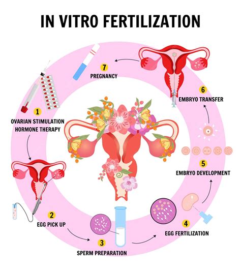 Infographic: Procesul Fertilizarii In Vitro la Euromaterna
