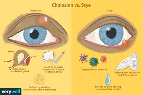 Schema comparației: orjelet vs. chalazion vs. conjunctivită