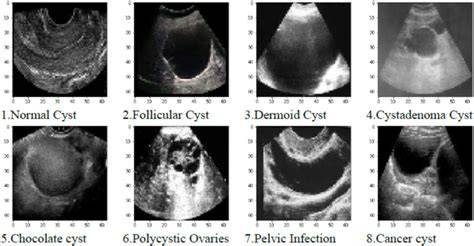 Infografic: Etape diagnostice pentru chisturile ovariene foliculare