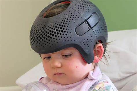 Casca ortopedica pentru corectarea plagiocefaliei la bebelusi