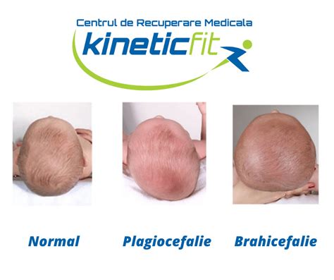 Comparatie vizuala intre un cap normal si un cap cu plagiocefalie