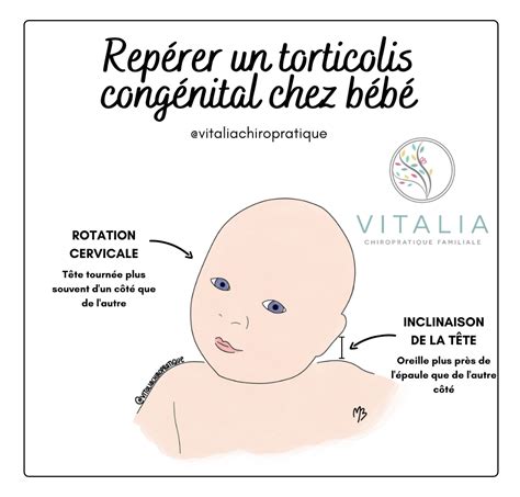 Schema anatomica: coordonarea muschilor gatului si efectele torticolis congenital