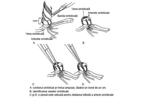Diagramă poziționare cateter ombilical arterial și venos