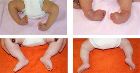 Schemă a metodei Ponseti pentru piciorul strâmb