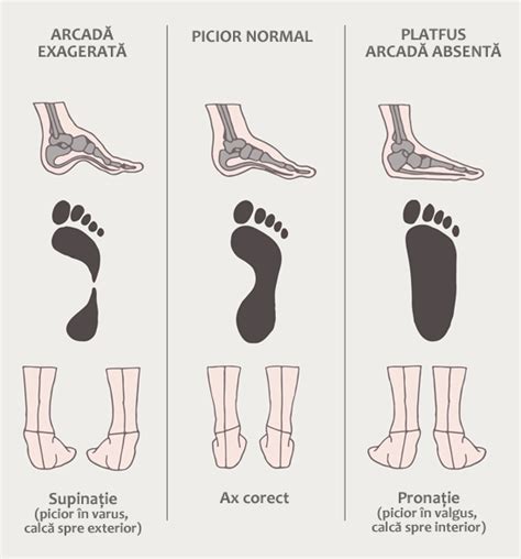 Ilustrație a diferitelor tipuri de picior plat și picior var equin