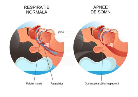 Diagramă a mecanismului obstructiv vs central în apneea în somn