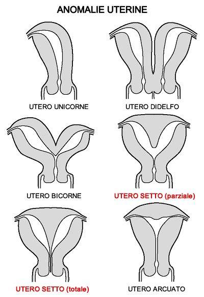 _infographic: Clasificare malformații uterine (septat, arcuat, bicorn, didelf, unicorn)