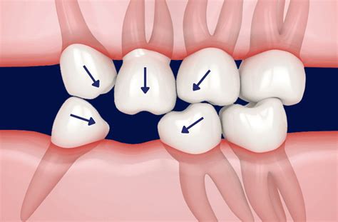 Infografic despre consecințele dinților înghesuiți