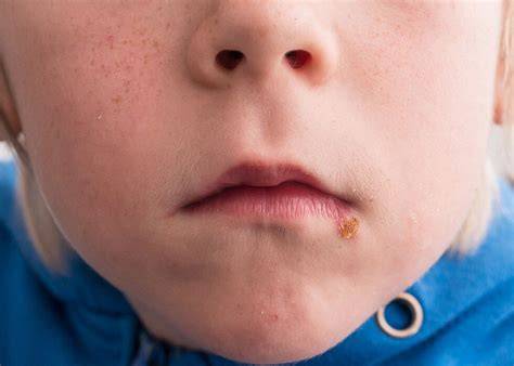 Impetigo stafilococic la bebeluși