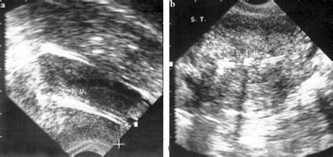 Diagramă: localizarea fibroamelor si impactul asupra cavitatii uterine