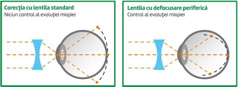Ilustrație a ochiului miop