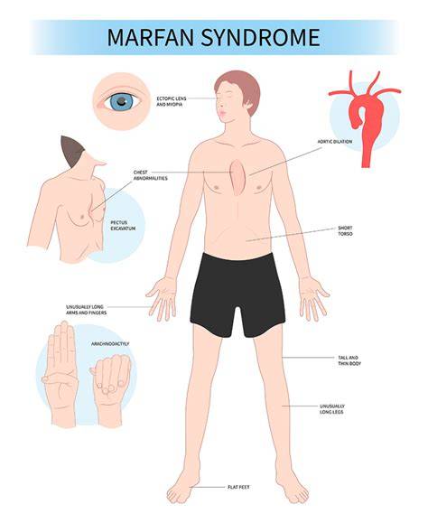 Infografic: Sistemele afectate de sindromul Marfan (cardiovascular, ocular, scheletal)