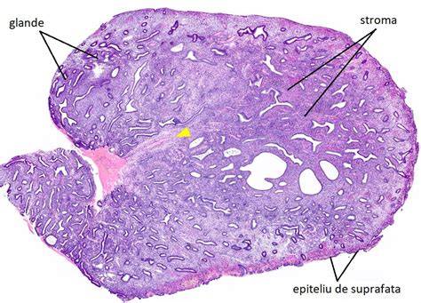 Infografic: Tipuri histologice ale cancerului endometrial