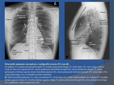 Investigații imagistice în ventilația neonatală: radiografie toracică pentru evaluarea volumului pulmonar