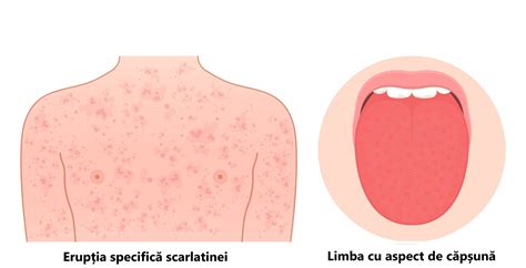 Infografic: Scarlatina - simptome, transmitere și tratament