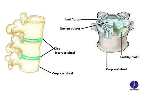 Infografic: structura discului intervertebral (nucleu pulpos si inel fibros) si tipuri de hernie