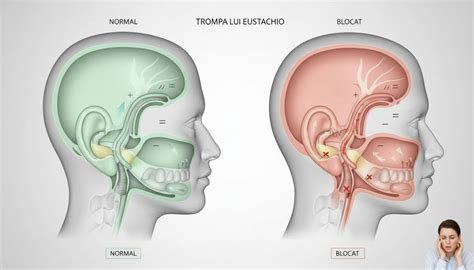 Schema care ilustrează blocarea trompei lui Eustachio de către vegetațiile adenoide mărite