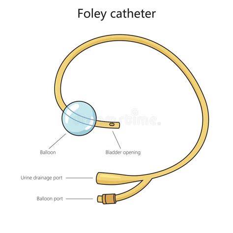 Diagramă detaliată a utilizării cateterului urinar în cezariană
