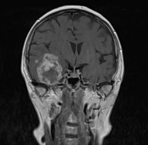 IRM cerebral cu substanță de contrast