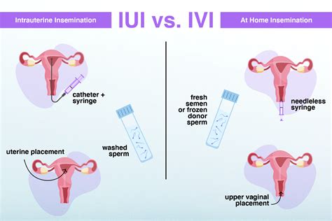 Grafic comparativ: ritmul sarcinilor dupa tipul de tratament (IUI vs FIV/ICSI)