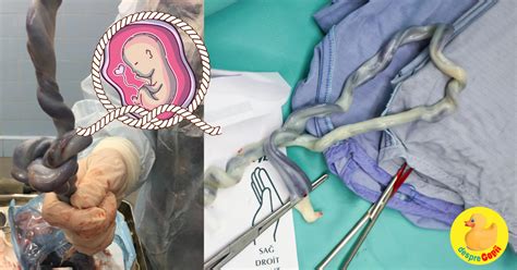 Ecografie prenatală cu cordon ombilical înfășurat în jurul gâtului fătului