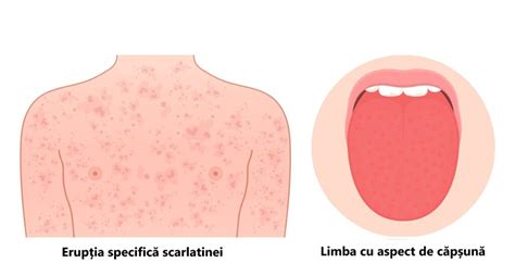 Erupție cutanată specifică scarlatinei