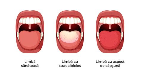 Limba zmeurie în scarlatină