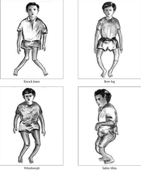 Deformări osoase cauzate de rahitism