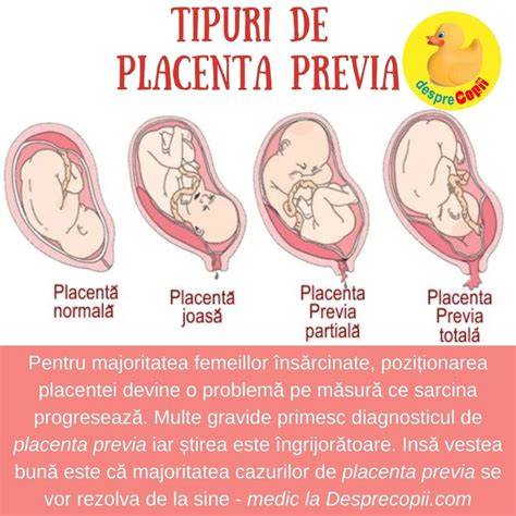 Infografic: Clasificare placenta previa, factori de risc și etape ale managementului