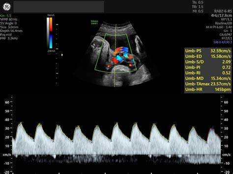 Diagramă Doppler fetal și uterin