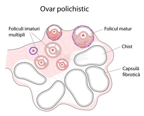 Ilustratie a sindromului ovarului polichistic