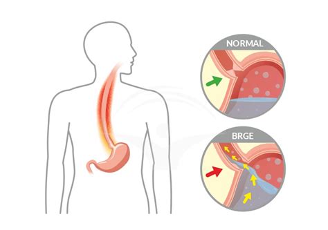 Schema bolii de reflux gastroesofagian