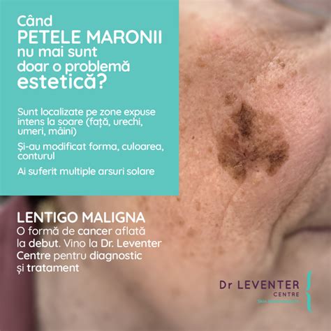 Infografic: Ghid rapid pentru prevenția petelor maronii pe piele