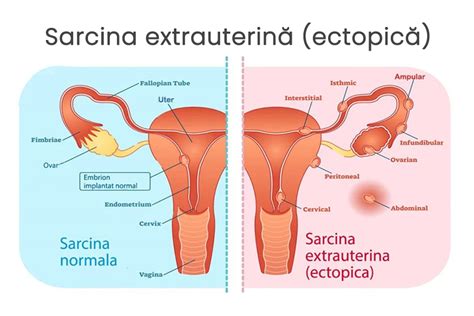 sarcină ectopică