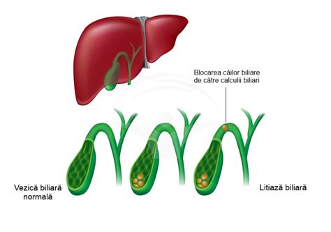Diagrama complicațiilor litiazei biliare