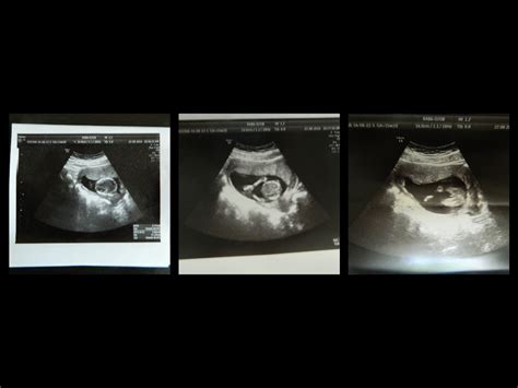 ecografie cu un fetus ascultând sunet