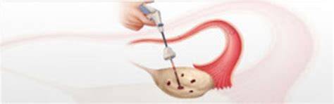 drilling ovarian laparoscopic