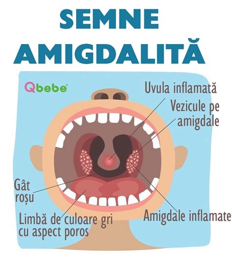 Infografic: pașii de evaluare pentru amigdalită la copii în spital