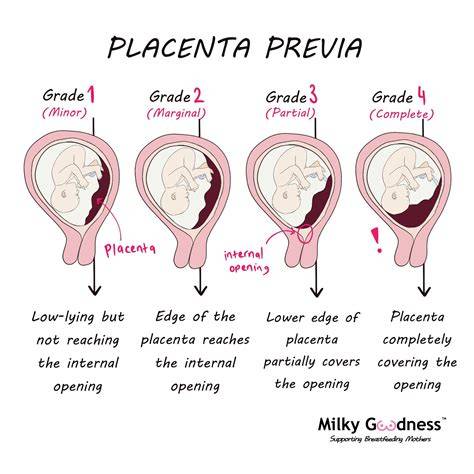 Infografic: Clasificarea placenta praevia și riscurile ascuțiute