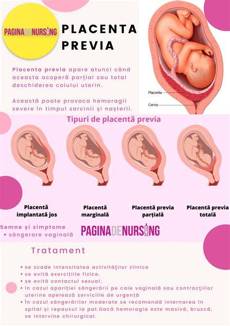 Infografic despre mecanismul placentei si localizarea acesteia in uter
