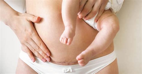 Schema operației de cezariană